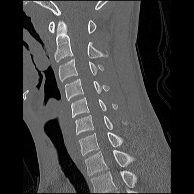 C5 facet fracture (Radiopaedia 58374-65499 Sagittal bone window 39).jpg