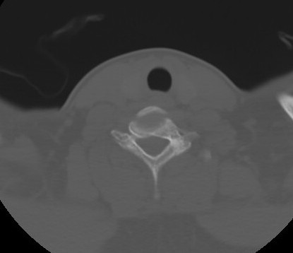 C7 laminar fracture and Klippel-Feil syndrome (Radiopaedia 86710-102850 Axial bone window 57).jpg