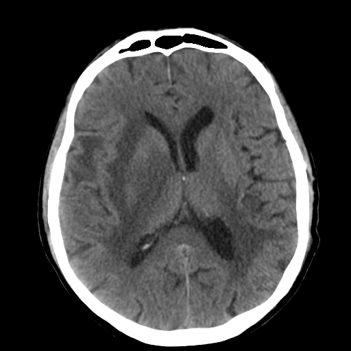 File:CNS lymphoma (Radiopaedia 36983-38639 Axial non-contrast 21).png