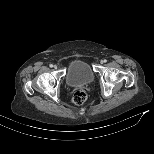 Calcified adrenal glands and Spigelian hernia (Radiopaedia 49741-54988 A 235).jpg