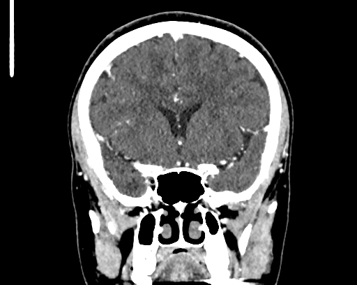 Calcified cerebral hydatid cyst (Radiopaedia 65603-74717 C 24).jpg