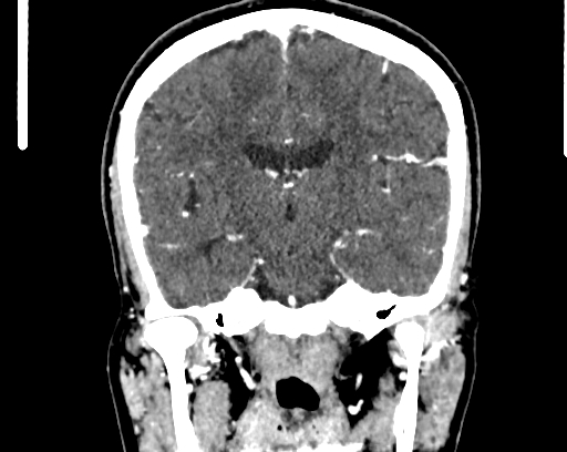 Calcified cerebral hydatid cyst (Radiopaedia 65603-74717 C 38).jpg
