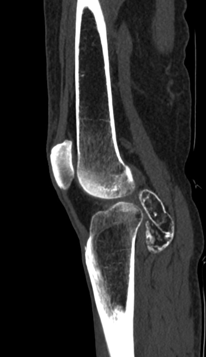 Calcified hematoma - popliteal fossa (Radiopaedia 63938-72763 Sagittal bone window 70).jpg