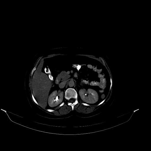 File:Calcified hydatid cyst of the liver (Radiopaedia 21212-21112 Axial bone window 20).jpg