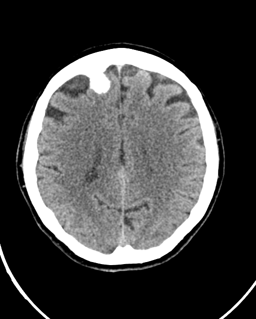 Calcified meningioma (Radiopaedia 74361-85243 Axial non-contrast 19).jpg