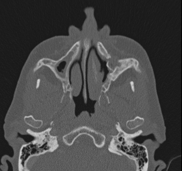 Caldwell-Luc operation (Radiopaedia 52329-58225 Axial bone window 38).jpg