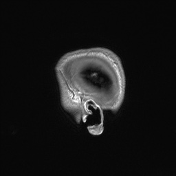 File:Callosal dysgenesis with interhemispheric cyst (Radiopaedia 53355-59335 Sagittal T1 167).jpg
