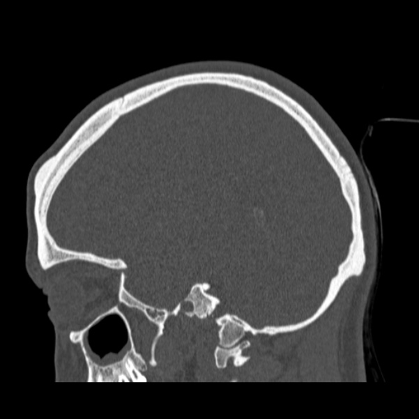 Calvarial osteoma (Radiopaedia 36520-38079 Sagittal bone window 40).jpg
