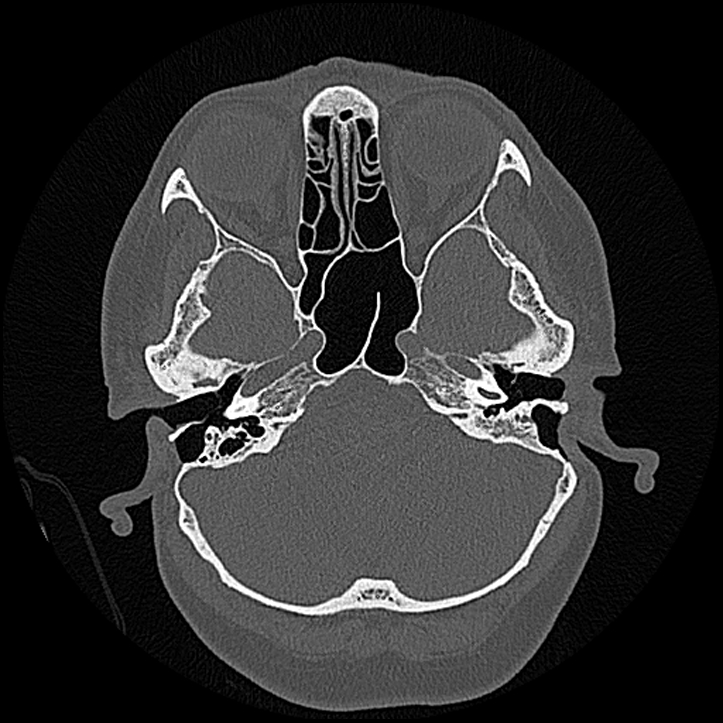 Canal up mastoidectomy (Radiopaedia 78108-90638 Axial bone window 62).jpg