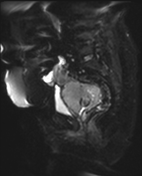 Cancer cervix - stage IIb (Radiopaedia 75411-86615 Sagittal DWI 11).jpg