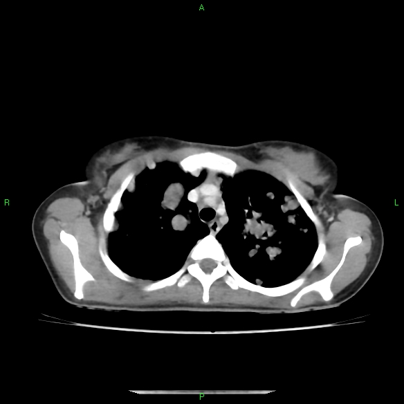 File:Cannon ball metastases - synovial sarcoma (Radiopaedia 26135-26271 C 9).jpg