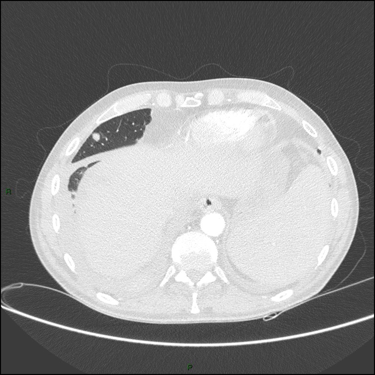 Cannonball metastases (Radiopaedia 82110-96150 Axial lung window 156).jpg