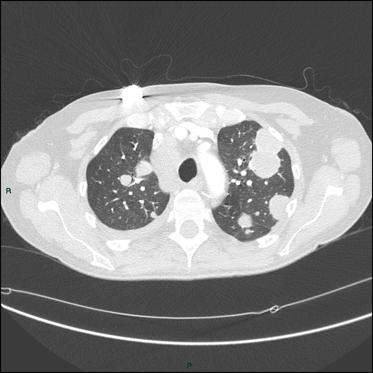 Cannonball metastases (Radiopaedia 82110-96150 Axial lung window 56).jpg