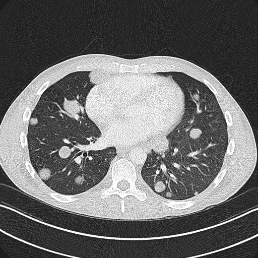 Cannonball metastases - testicular choriocarcinoma (Radiopaedia 84510-99891 Axial lung window 61).jpg