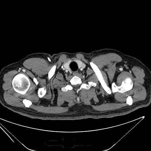 File:Cannonball pulmonary metastases (Radiopaedia 67684-77101 D 4).jpg