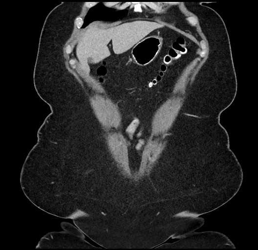 File:Carcinoid tumor - terminal ileum (Radiopaedia 60931-68739 B 3).jpg