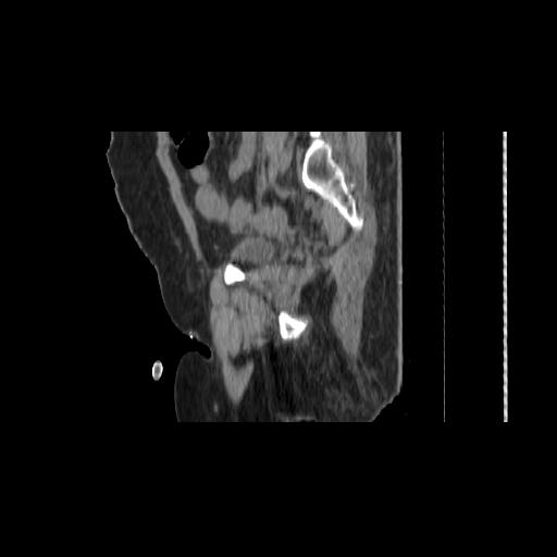 File:Carcinoma cervix- brachytherapy applicator (Radiopaedia 33135-34173 D 135).jpg