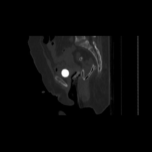 File:Carcinoma cervix- brachytherapy applicator (Radiopaedia 33135-34173 Sagittal bone window 101).jpg