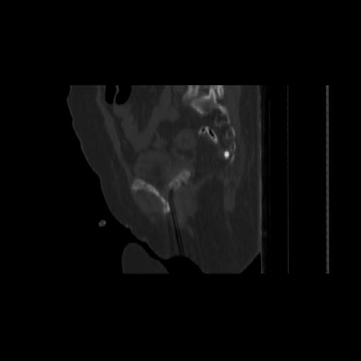Carcinoma cervix- brachytherapy applicator (Radiopaedia 33135-34173 Sagittal bone window 115).jpg