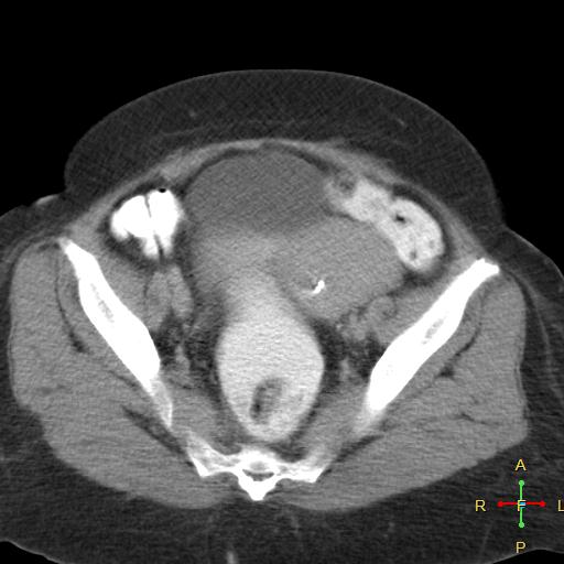 File:Carcinoma of sigmoid colon (Radiopaedia 23071-23100 C+ delayed 23).jpg