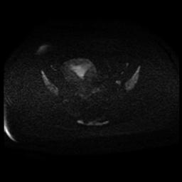 Carcinoma of the cervix (Radiopaedia 89018-105858 Axial DWI 76).jpg