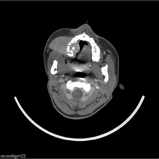 Carcinoma of the maxillary antrum (Radiopaedia 53805-59888 Axial C+ delayed 44).jpg