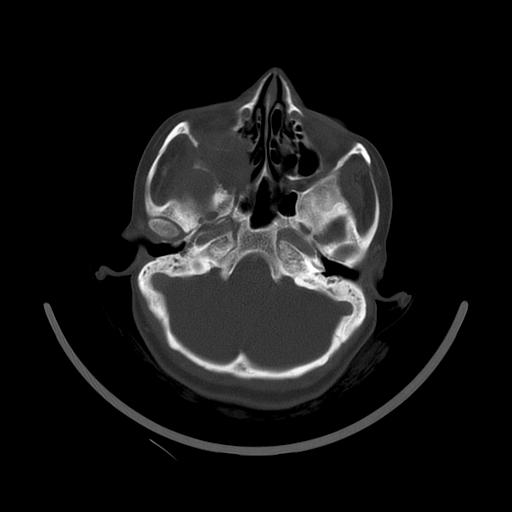 Carcinoma of the maxillary antrum (Radiopaedia 53805-59888 Axial bone window 37).jpg