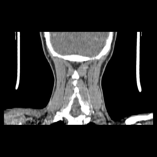 Carcinoma of the maxillary antrum (Radiopaedia 53805-59888 Coronal C+ delayed 139).jpg