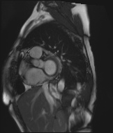 Cardiac amyloidosis (Radiopaedia 51404-57150 Sagittal CINE SSFP 268).jpg
