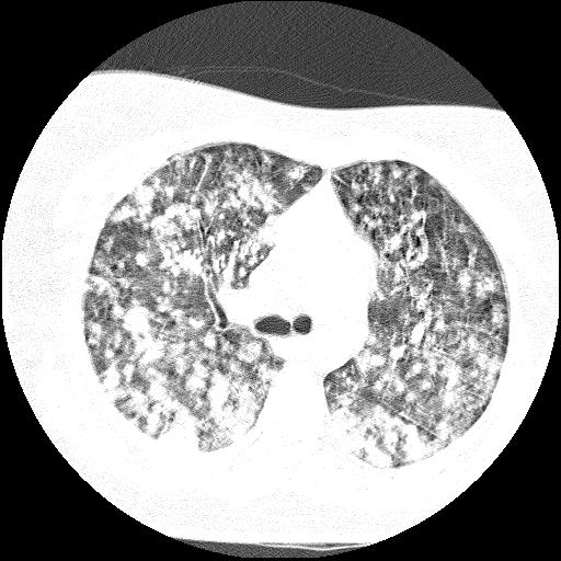 Cardiac angiosarcoma (Radiopaedia 66010-75181 Axial lung window 60).jpg
