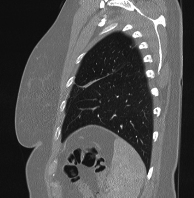 File:Cardiac sarcoidosis (Radiopaedia 74548-85534 Sagittal lung window 13).jpg