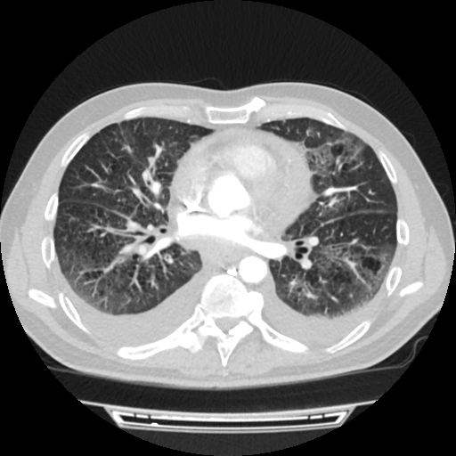 Cardiac tamponade (Radiopaedia 78607-91368 Axial lung window 49).jpg