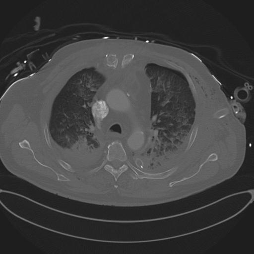 Cardiac trauma (Radiopaedia 32874-33858 Axial bone window 30).jpg