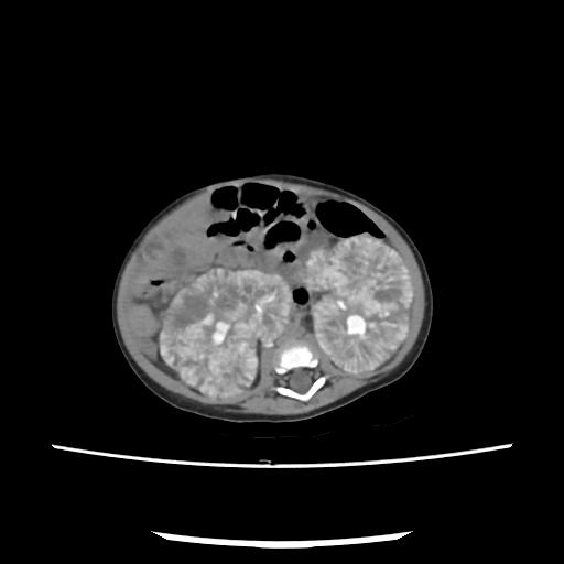 Caroli disease with autosomal recessive polycystic kidney disease (ARPKD) (Radiopaedia 89651-106703 E 135).jpg