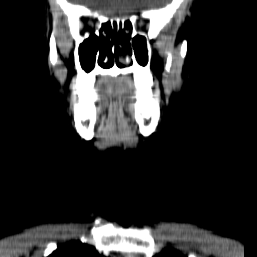 File:Carotid body tumor (Radiopaedia 27890-28124 B 19).jpg