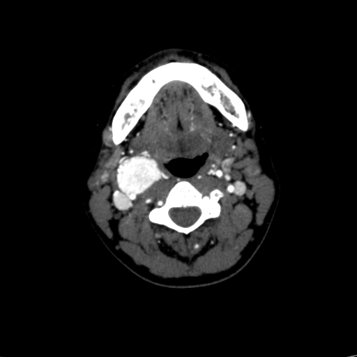 File:Carotid body tumor (Radiopaedia 39845-42300 B 40).jpg