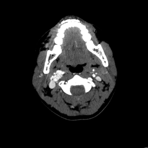 File:Carotid body tumor (Radiopaedia 39845-42300 B 51).jpg