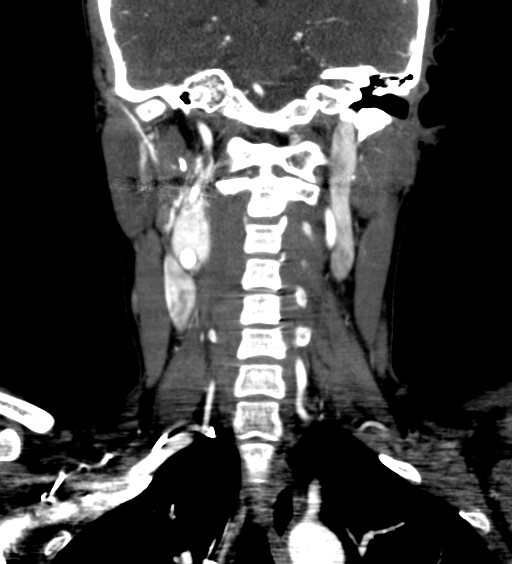 File:Carotid body tumor (Radiopaedia 39845-42300 C 52).jpg