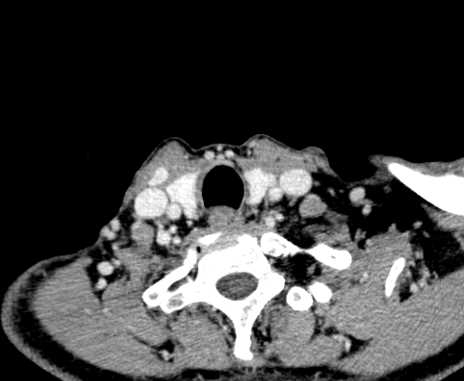 Carotid body tumor (Radiopaedia 61750-69757 Axial Post contrast 99).jpg