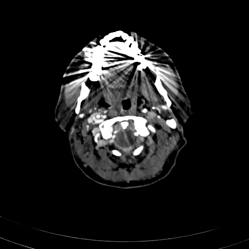 Carotid body tumor (Radiopaedia 83615-98727 A 35).jpg