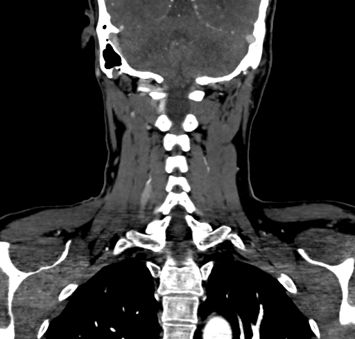 File:Carotid body tumor (Radiopaedia 83615-98727 B 99).jpg
