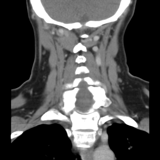 File:Carotid body tumor (paraganglioma) (Radiopaedia 38586-40729 B 32).jpg