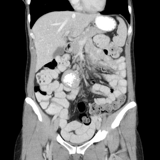 Castleman disease with fibrous pseudotumor in the abdomen (Radiopaedia 77296-89373 B 36).jpg