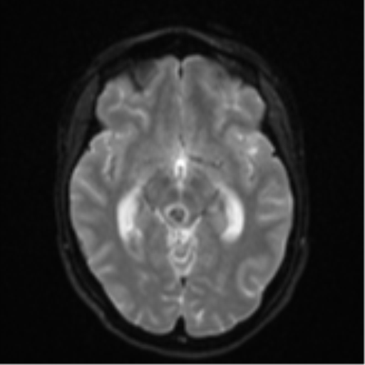 File:Cavernoma with bleed - midbrain (Radiopaedia 54546-60774 Axial DWI 11).png