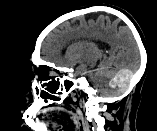 Cavernous hemangioma of the cerebellar falx (Radiopaedia 73025-83723 B 128).jpg
