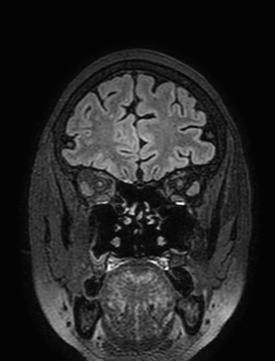 Cavernous hemangioma of the cerebellar falx (Radiopaedia 73025-83724 Coronal FLAIR 70).jpg