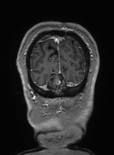 Cavernous hemangioma of the cerebellar falx (Radiopaedia 73025-83724 Coronal T1 C+ 343).jpg