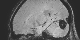 Cavernous hemangioma of the cerebellar falx (Radiopaedia 73025-83724 Sagittal BOLD 134).jpg