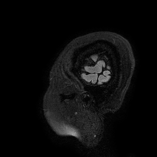 Cavernous hemangioma of the cerebellar falx (Radiopaedia 73025-83724 Sagittal FLAIR 213).jpg