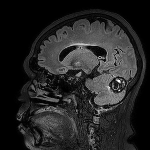 Cavernous hemangioma of the cerebellar falx (Radiopaedia 73025-83724 Sagittal FLAIR 82).jpg
